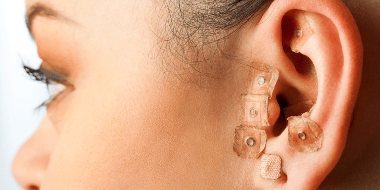 Auriculoterapia